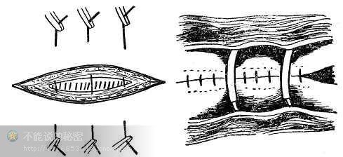 [转载]外科缝合的基本方法